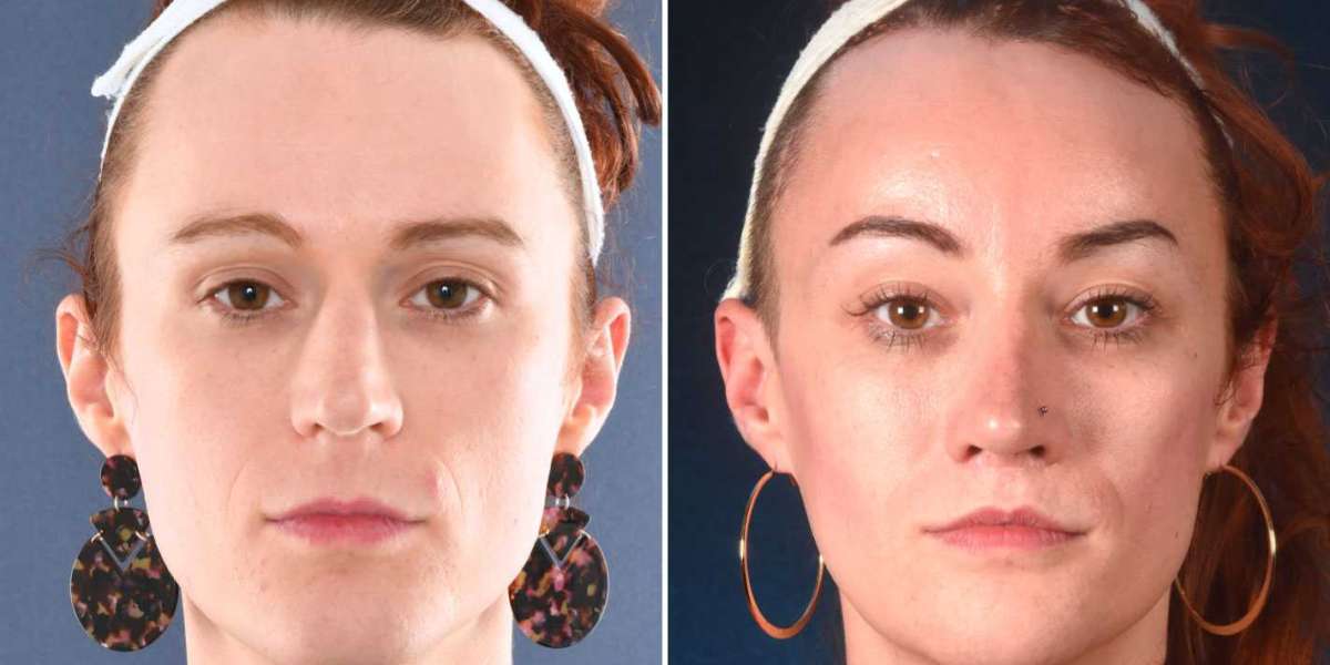 Hair Transplant Transgender