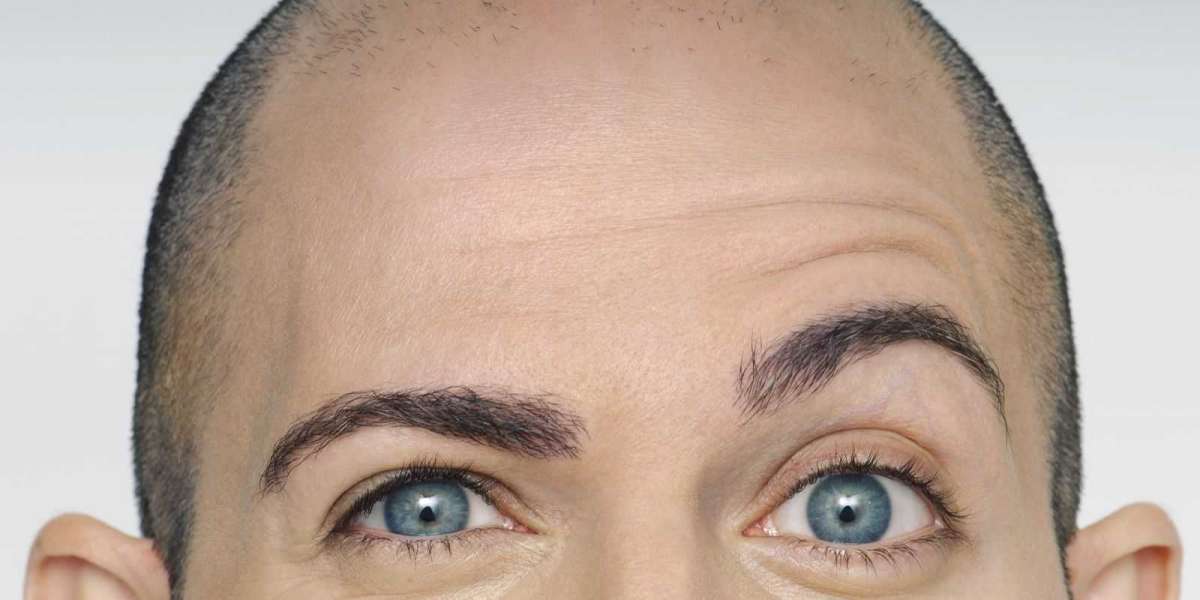 Men's Eyebrow Transplant