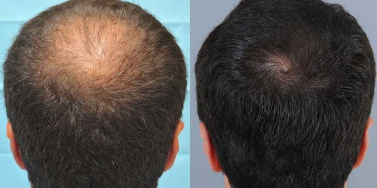 Hair Restoration: An Efficient Method Of Restoring Your Natural Hairline