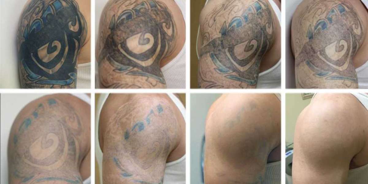 Choosing the Best Tattoo Removal Services in Las Vegas