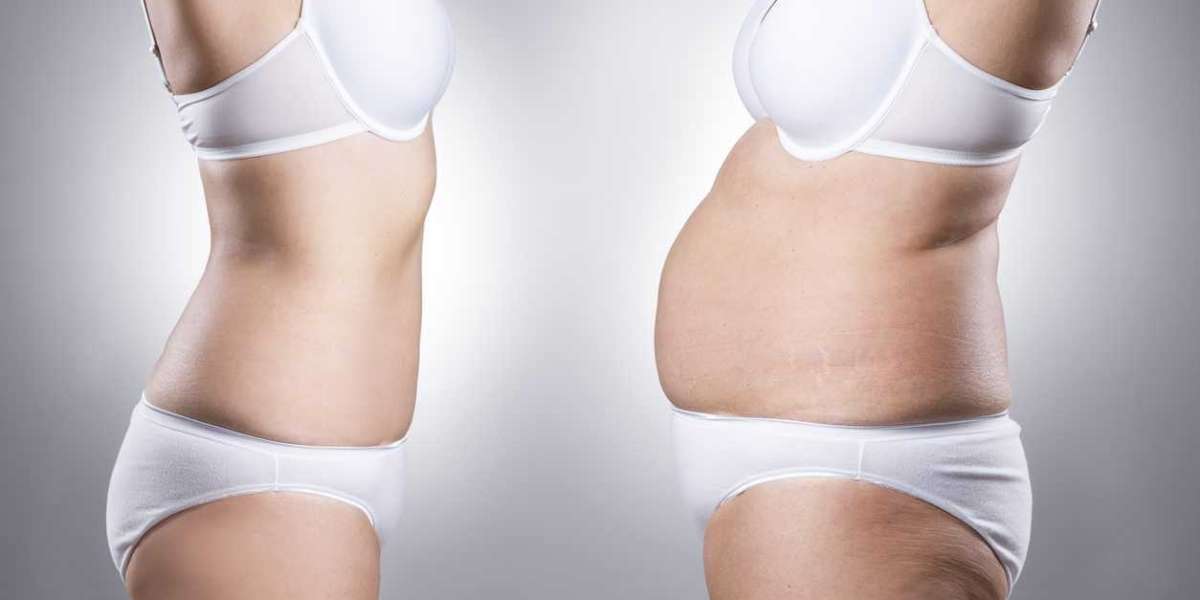What Are the Alternatives to Fat Loss Treatment?