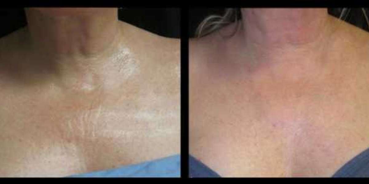 Microneedling On Chest