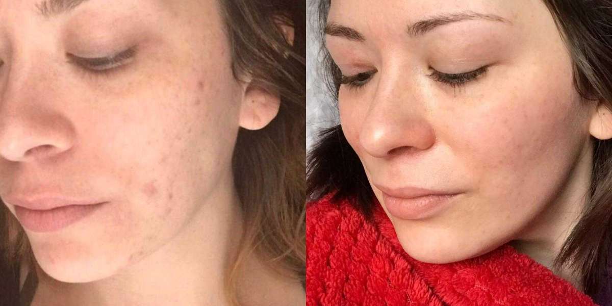 What does Accutane do to your body?