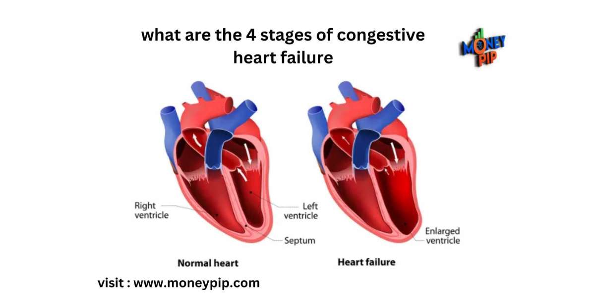 Navigating the Four Stages of Congestive Heart Failure