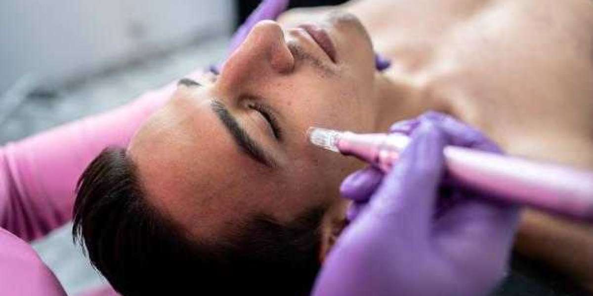 An Overview of Microneedling Benefits