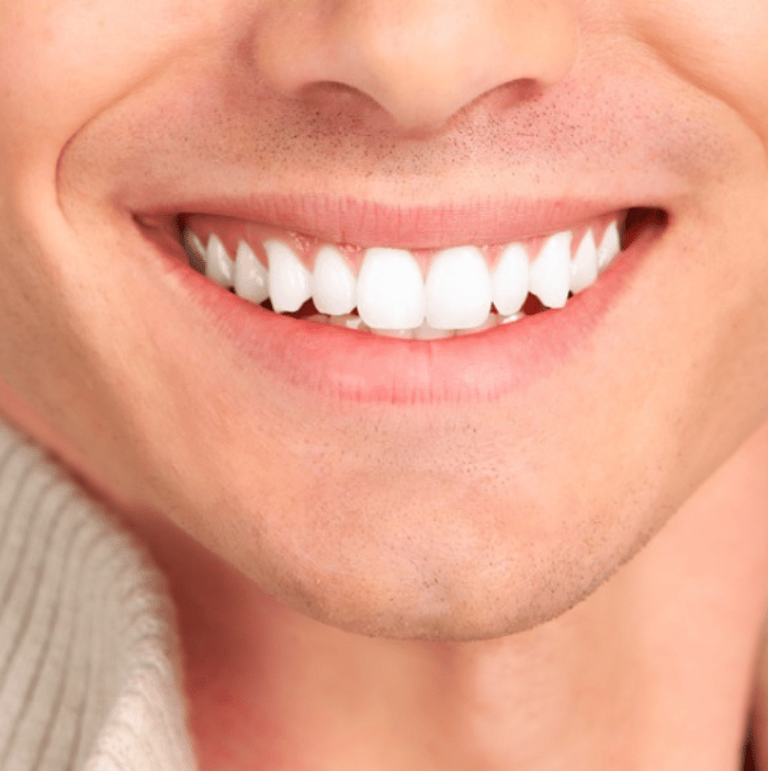 Best Teeth Whitening Clinic in Dubai| Versailles Dental Clinic