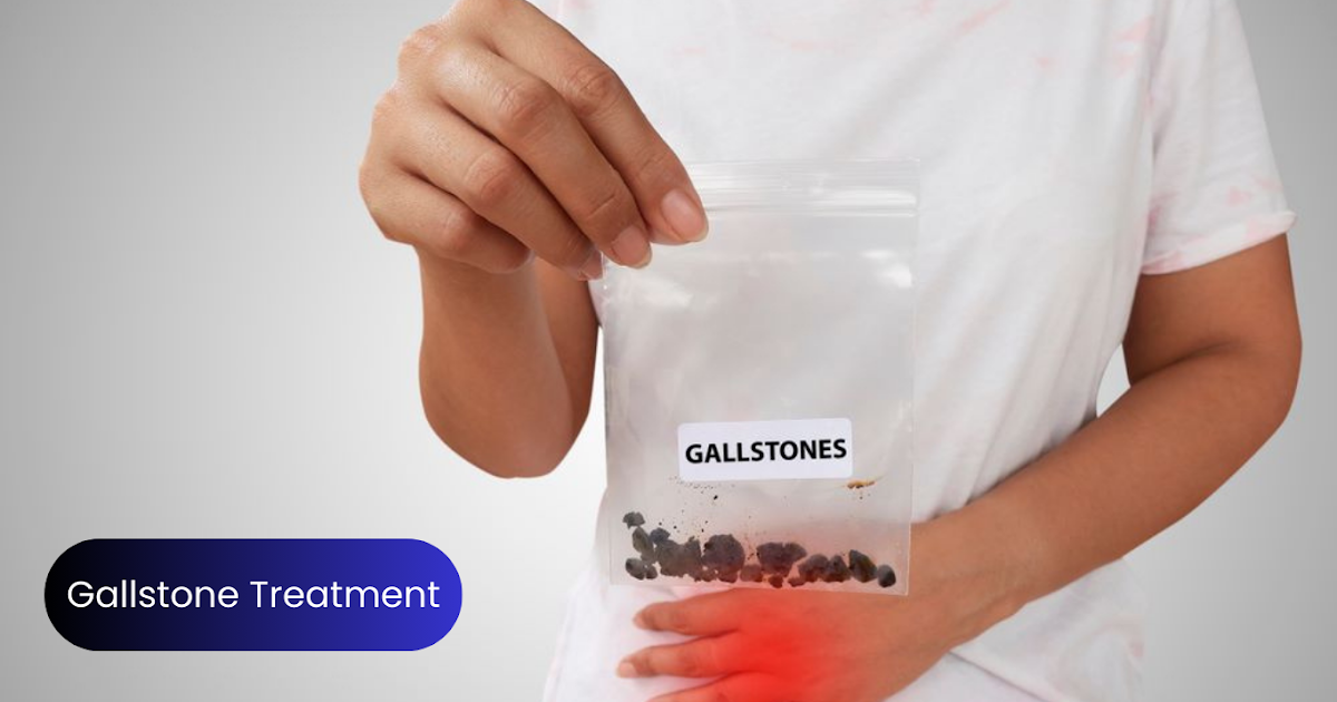 Understanding Gall Stones: Causes, Symptoms, and Prevention Tips