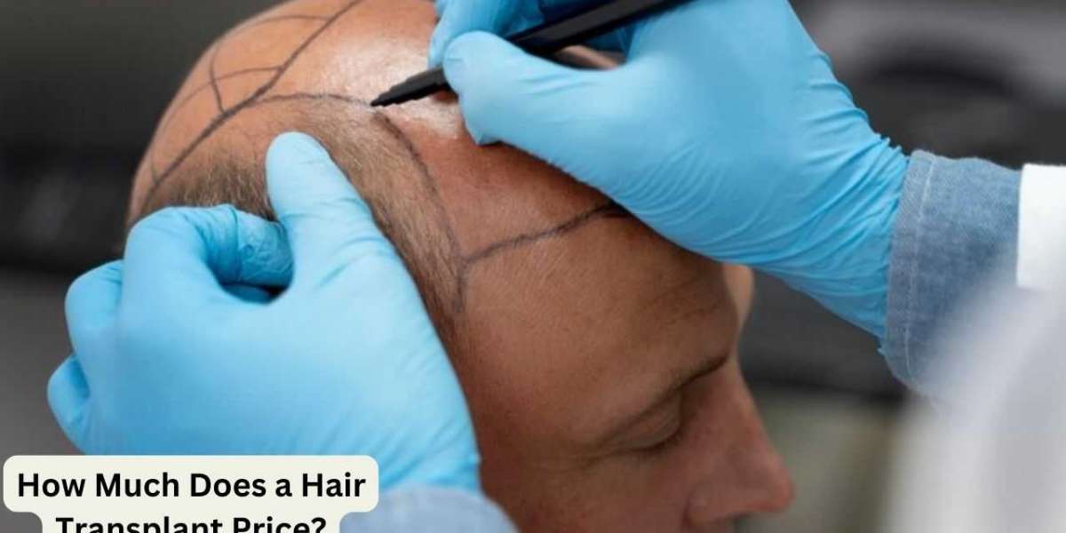 How Much Does a Hair Transplant Price?