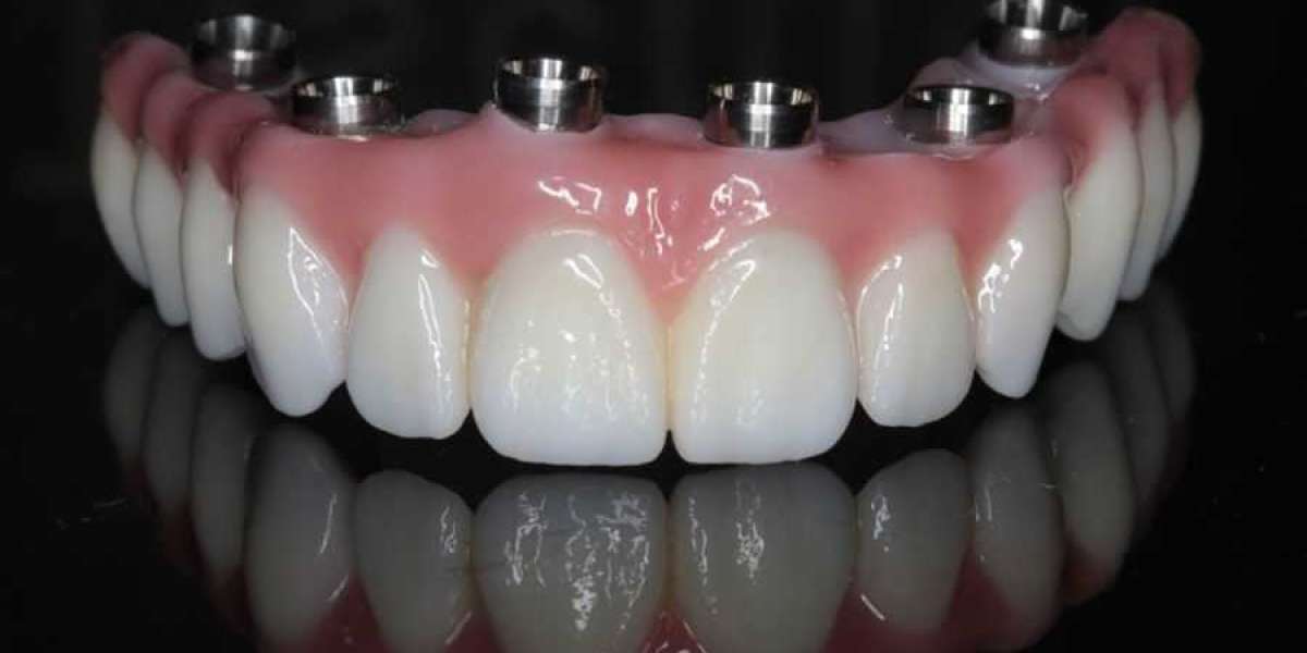 Dental Implants - The Newest and Most Innovative Way to Replace Missing Teeth