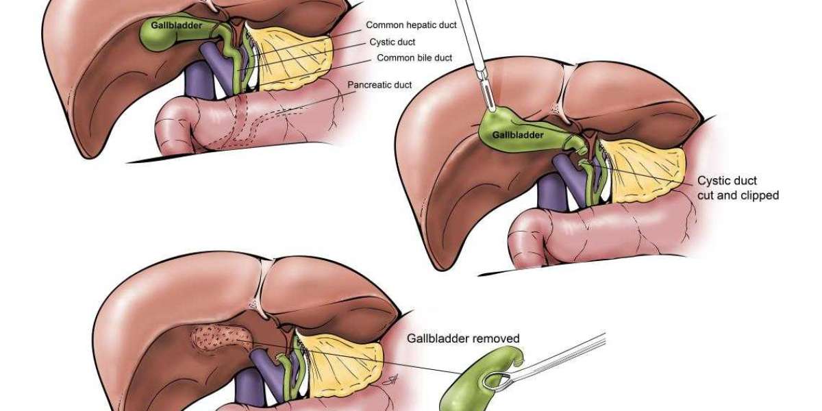 Best Gallbladder Removal Surgery in Delhi by Dr. Tarun Mittal